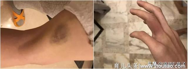 郑刚斥女星产后虐待儿子才暴力抢回，网友：这真的不是蚊子咬的吗