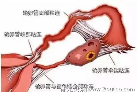 备孕1年没反应想要放弃，做了这项手术3年内怀2男宝，接好孕！