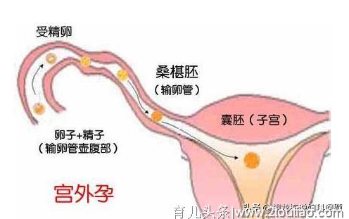 孕期的定时炸弹，【宫外孕】究竟有多可怕？