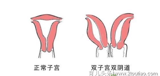 西昌双阴道双子宫美女做人流 生殖发育先天畸形人工流产案例实录