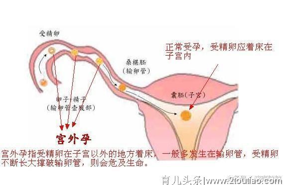 正能量！被诊宫外孕，10天后B超翻盘！宫内好孕！