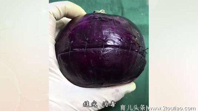 为什么剖腹产手术，开刀只需5分钟，但缝合要一个小时呢？