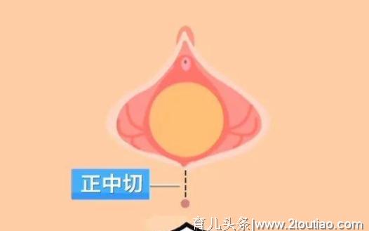 侧切：明明是顺产，为何还要挨一刀？