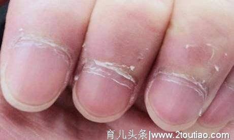 宝宝出现这6种症状，说明缺锌严重了，缺锌不利于宝宝健康成长