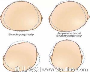 顺产宝宝刚出生时头部变形怎么办？别怕，做好这点就可以纠正过来