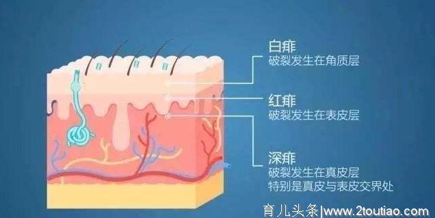 宝宝热出一身痱子，婆婆竟然说不准吹空调！婴儿热痱该如何护理？