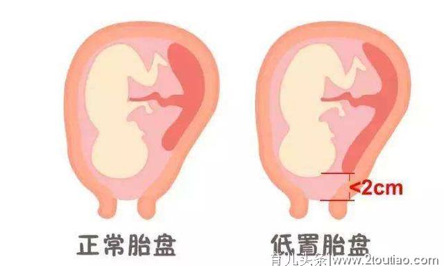 胎盘低置不可怕，孕妇想要胎盘长上去，孕期做好这6点