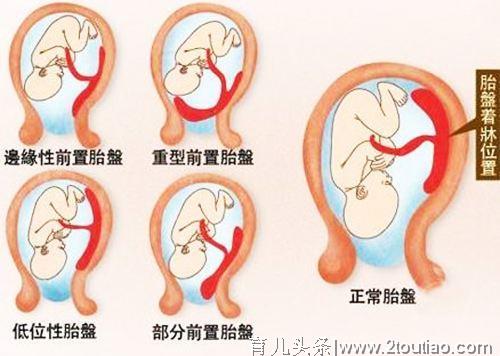 胎盘低置不可怕，孕妇想要胎盘长上去，孕期做好这6点