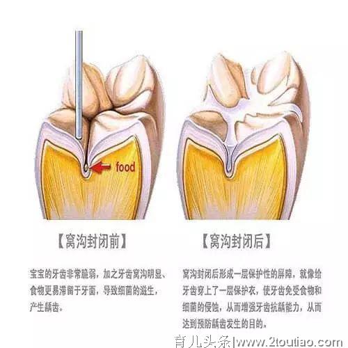 窝沟封闭是我送给孩子的生日礼物！记录3岁女儿做窝沟封闭全过程