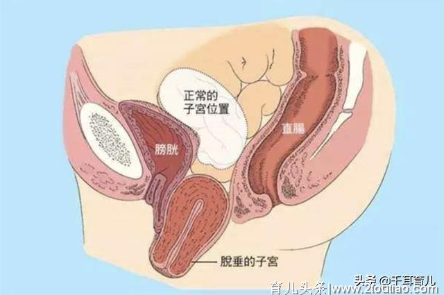 备孕、怀孕、产后妈妈都应该重视的不是保持身材，而是盆底肌锻炼