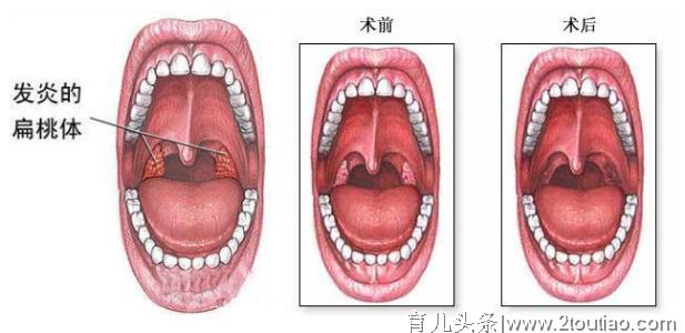 孩子睡觉爱打鼾说明睡得香？医生说，别大意，可能是这种疾病造成