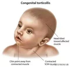 小儿斜颈：令孩子变丑、父母崩溃的疾病到底该怎么治？