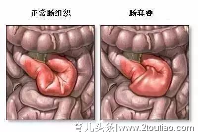 宝宝异常哭别轻视，这个病发现晚了可能肠坏死