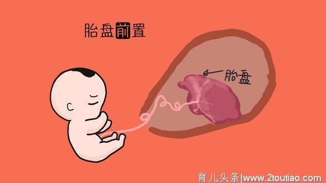 剖腹产有“后遗症”，能顺尽量别剖，别等到生二胎时才后悔