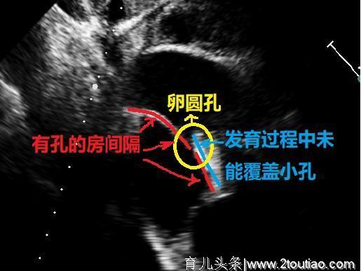 心脏彩超提示宝宝卵圆孔未闭，这难道是先天性心脏病吗？