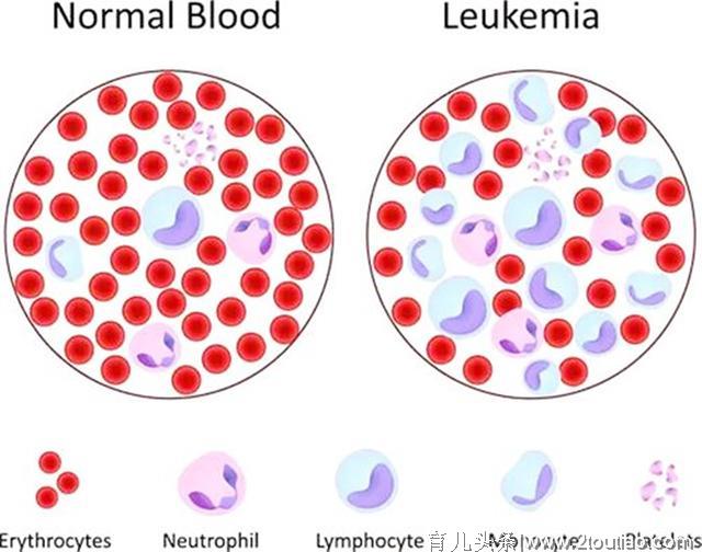 白血病为何总“找”孩子？“风险性”元凶要提前预防，看你家有吗