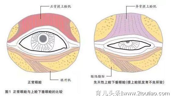 当心宝宝大小眼，很可能是一种儿童眼疾！