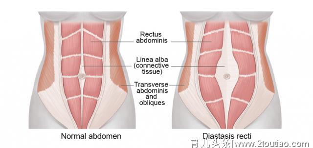 辣妈们闻风丧胆的腹直肌分离，产后该如何正确恢复？