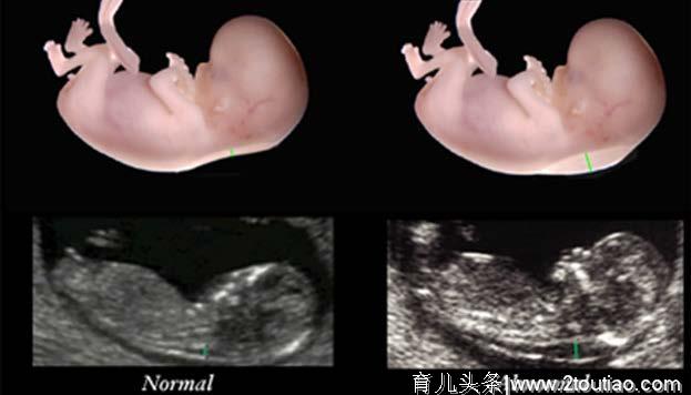 怀孕3个月，看懂B超单上这两个数据，胎儿就没有什么小秘密了