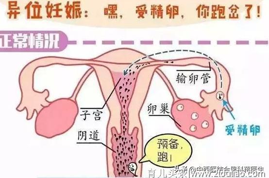 宫外孕，无法忘却的痛——试管婴儿成功案例分享