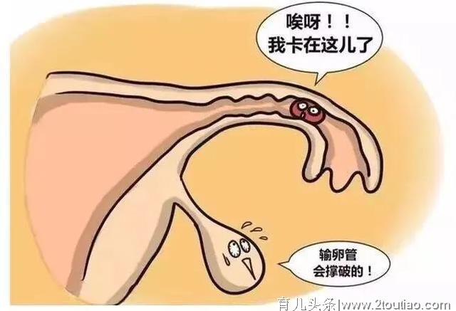 宫外孕保守与手术治疗哪个更好？