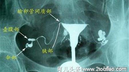 多囊卵巢备孕两年未怀孕，终于鼓起勇气做造影，谈谈我的造影经过