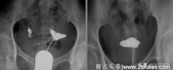 多囊卵巢备孕两年未怀孕，终于鼓起勇气做造影，谈谈我的造影经过