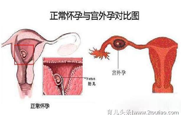 宫外孕一般在怀孕多久后能发现？宫外孕的这几个早期症状要知道！