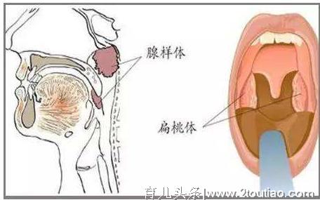 当孩子查出腺体肥大时，为啥医生坚持建议要做手术？