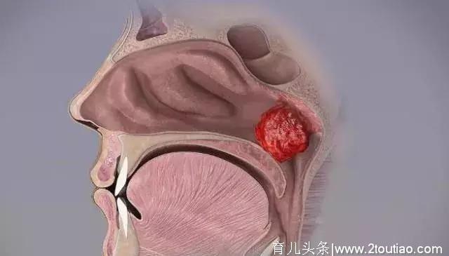 这种“打鼾”是病，影响孩子智力和颜值，再晚一点知道就迟了