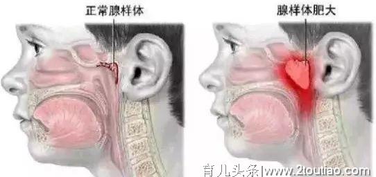 关注孩子的呼吸与睡眠 警惕儿童腺样体疾病