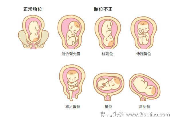 胎儿难产的5大原因，孕期做好这三点，分娩更顺利