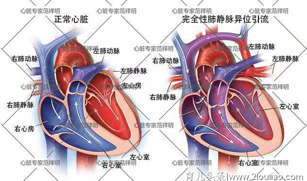 女宝宝先天性心脏病被治愈，长大后能怀孕吗？会不会遗传给孩子？