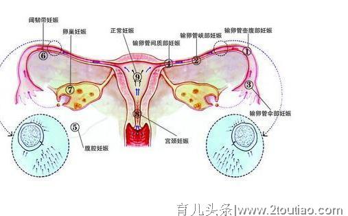 宫外孕是什么？怎样才能避免？