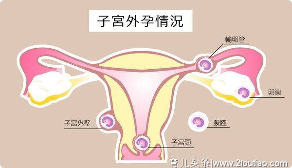 别太轻视宫外孕，你需要知道的宫外孕3种治疗方法