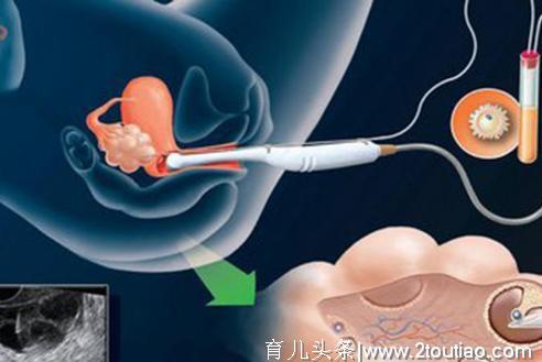 怀孕多久以后可以检查出是不是宫外孕？宫外孕有什么危害？