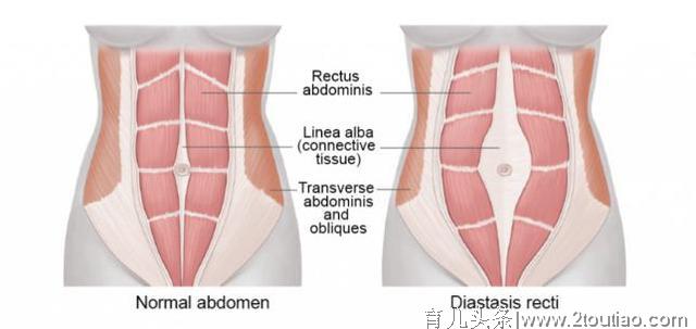 产后肚子松松垮垮？注意这可能是腹直肌分离