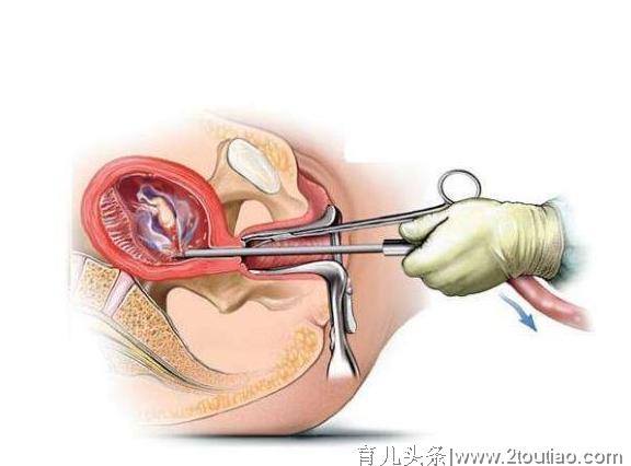 常见的流产方式，一个比一个残忍，关键是后遗症伤身体！