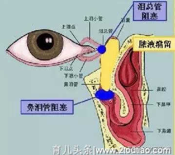 儿童常见的眼科疾病