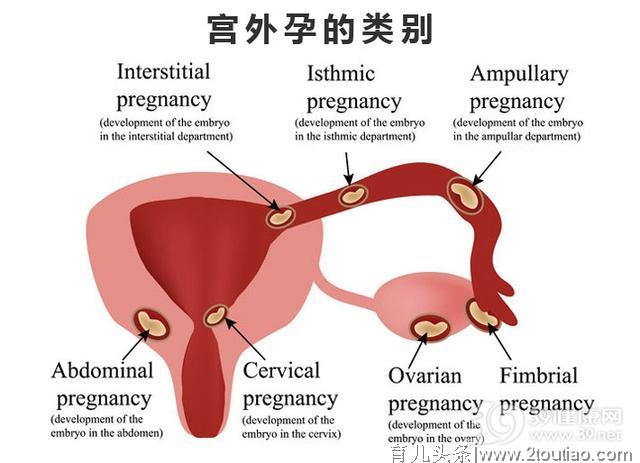 突然停经是怀孕了？三个症状提醒你可能是宫外孕！