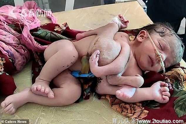 印度三胞胎自然分娩2个 哥哥健康妹妹4条腿3只手