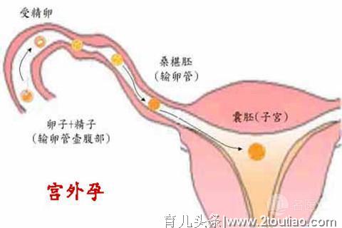 宫外孕是怎么回事