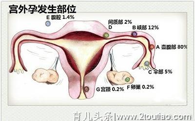 准妈妈必知：宫外孕的6大早期症状