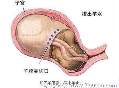 顺产真的比剖腹好吗，孕晚期有这七种迹象的孕妈要慎重选择了！