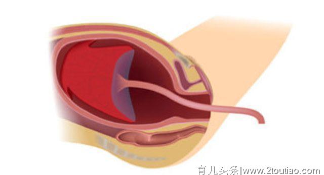 顺产是撕心裂肺的痛？一辈子都忘不了！九张图告诉你分娩真相