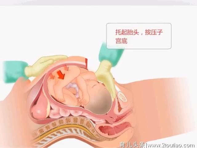 七张图带你看看，剖腹产手术如何进行，网友：看完真的心疼女人