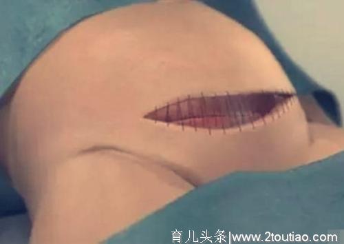 七张过程图带你了解，剖腹产是怎么进行的，看完心疼女人