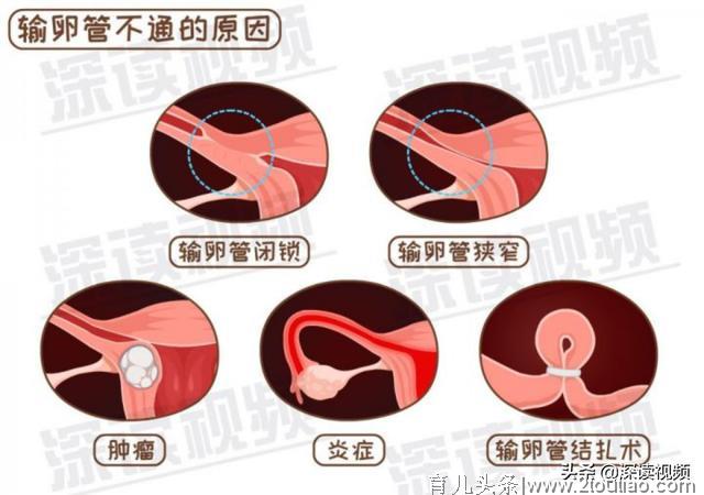 宫外孕是怎么回事儿？