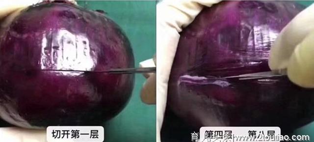 剖腹产就是“睡一觉”那么轻松？看这颗洋葱，才知道为母则刚