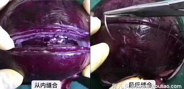 剖腹产就是“睡一觉”那么轻松？看这颗洋葱，才知道为母则刚